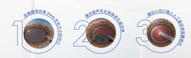 白内障手术步骤